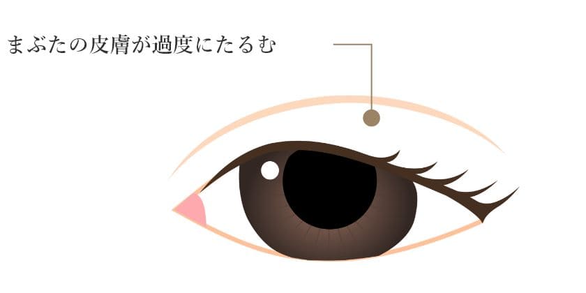 眼瞼皮膚弛緩症(がんけんひふしかんしょう)