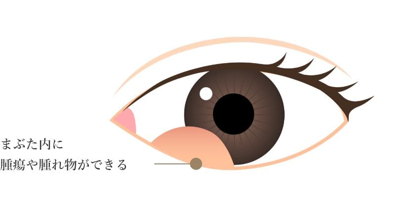 眼瞼腫瘍(がんけんしゅよう)