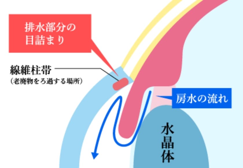 排水部分の目詰まり