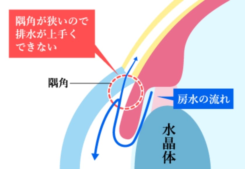 隅角が狭いので排水が上手くできない