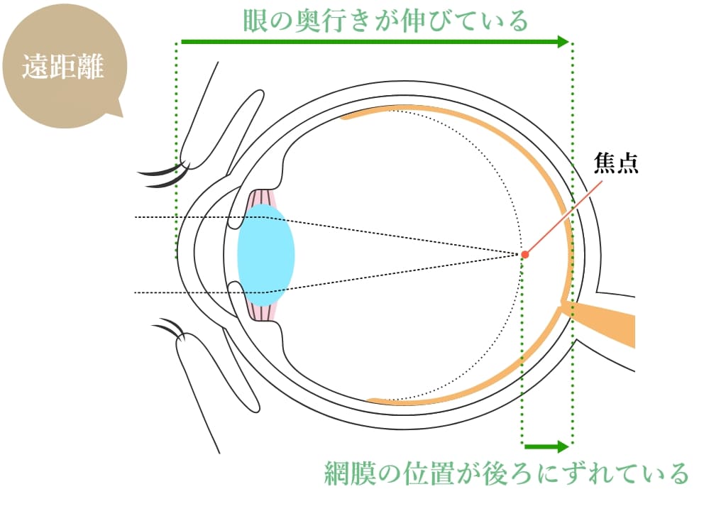 遠距離時の軸性近視の人の目の構造