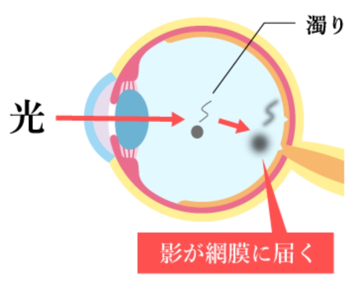 飛蚊症の原因イメージ