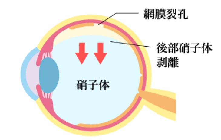 治療が必要な飛蚊症のイメージ