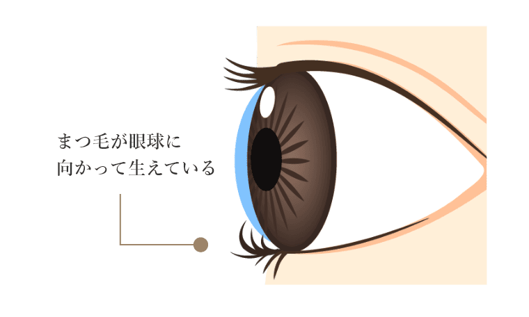 まつ毛が眼球に向かって生えている