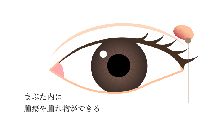 まぶた内に腫瘍や腫れ物ができる