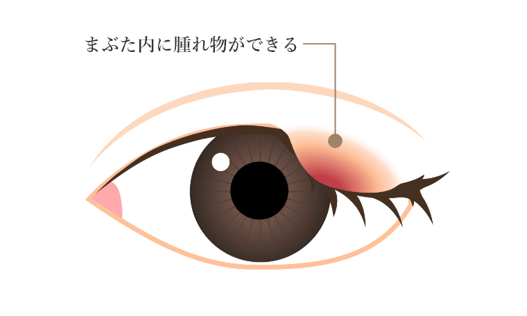 まぶた内に腫れ物ができる