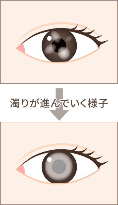 濁りが進んでいく様子