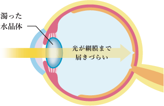白内障で水晶体が濁り光が散乱する眼球断面図