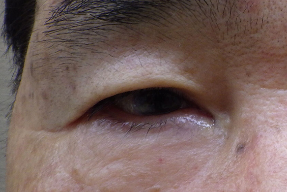 眼瞼下垂の症例01 術前画像