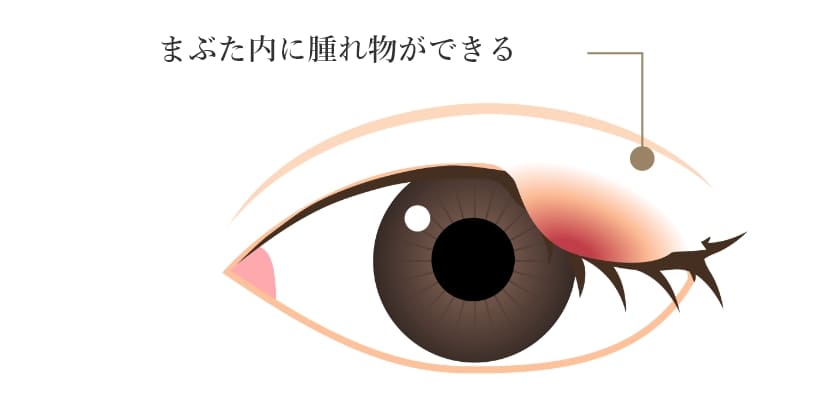 まぶた内に腫れ物ができる