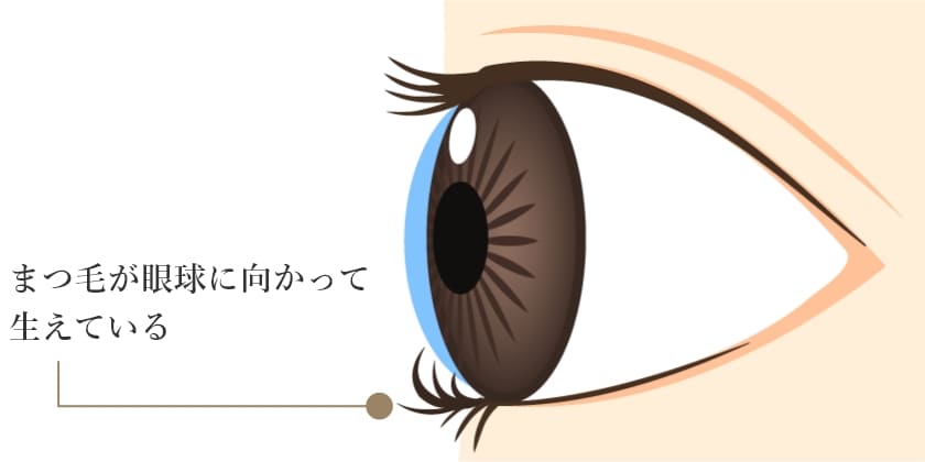 まつ毛が眼球に向かって生えている