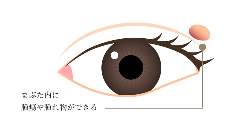まぶた内に腫瘍や腫れ物ができる
