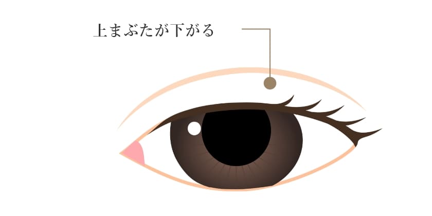 上まぶたが下がる